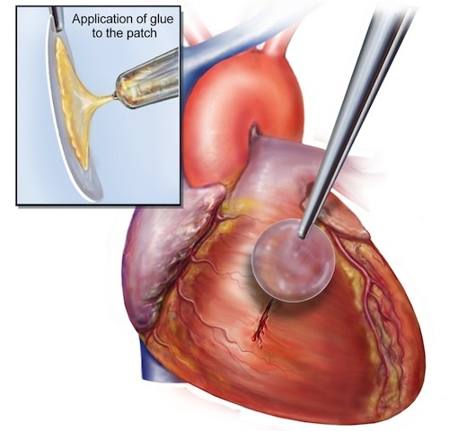 Heart Glue 1